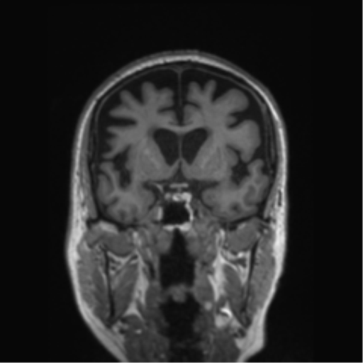 Behavioral variant frontotemporal dementia and late onset schizophrenia (Radiopaedia 52197-58083 Coronal T1 58).png