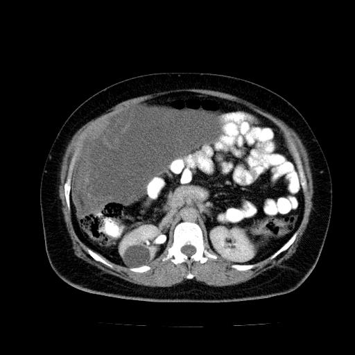 File:Benign spindle cell tumor - abdominopelvic (Radiopaedia 61300-69212 Axial C+ delayed 24).jpg