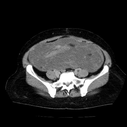 Benign spindle cell tumor - abdominopelvic (Radiopaedia 61300-69212 Axial C+ delayed 45).jpg