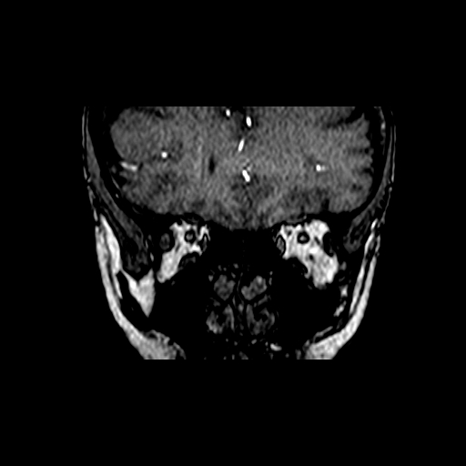 Berry aneurysm of the terminal internal carotid artery (Radiopaedia 88286-104918 Coronal TOF 10).jpg