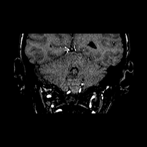 File:Berry aneurysm of the terminal internal carotid artery (Radiopaedia 88286-104918 Coronal TOF 79).jpg
