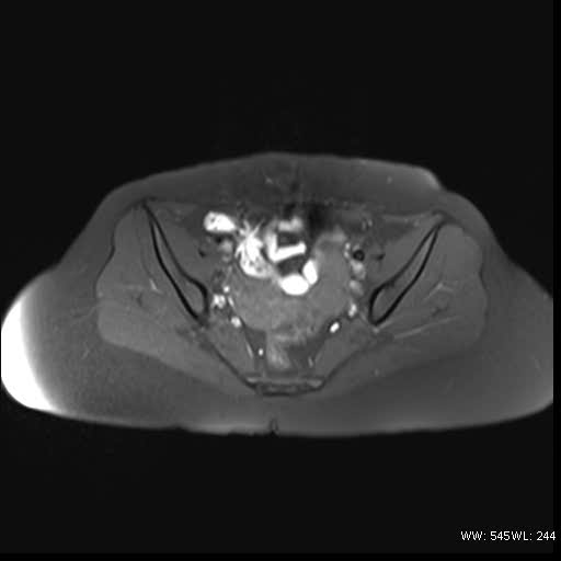 File:Bicornuate uterus- on MRI (Radiopaedia 49206-54297 Axial T1 fat sat 9).jpg