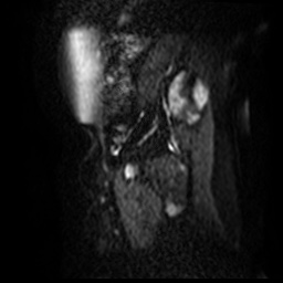 File:Bicornuate uterus (Radiopaedia 51676-57472 Sagittal DWI 6).jpg
