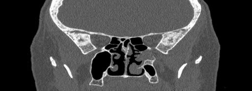 Bilateral Ectopic Infraorbital Nerves (Radiopaedia 49006-54084 Coronal bone window 55).jpg