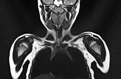 File:Bilateral Sprengel deformity with Klippel-Feil syndrome (Radiopaedia 66395-75650 Coronal T2 7).jpg