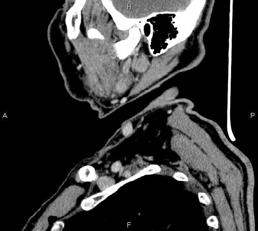 Bilateral Warthin tumors (Radiopaedia 84034-99263 D 61).jpg