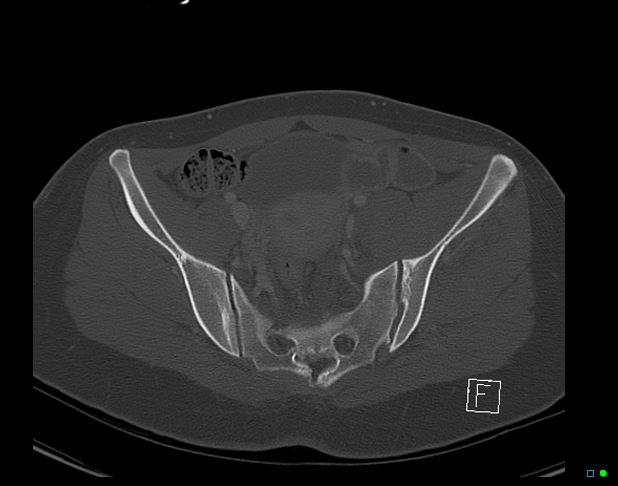 Bilateral acetabular fractures (Radiopaedia 79272-92308 Axial bone window 25).jpg