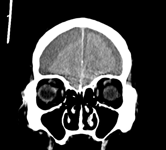 Bilateral acute on chronic subdural hematomas (Radiopaedia 78466-91146 Coronal non-contrast 16).jpg