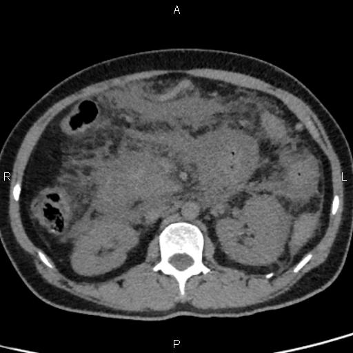 Bilateral adrenal gland hyperenhancement in pancreatitis (Radiopaedia 86642-102753 Axial non-contrast 48).jpg