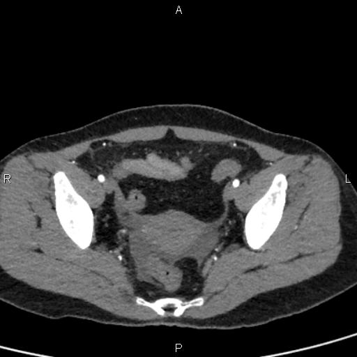 Bilateral adrenal gland hyperenhancement in pancreatitis (Radiopaedia 86642-102753 B 111).jpg