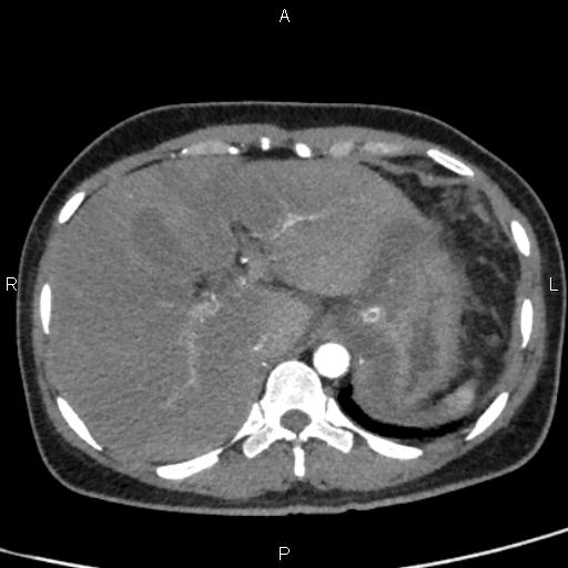 Bilateral adrenal gland hyperenhancement in pancreatitis (Radiopaedia 86642-102753 B 20).jpg