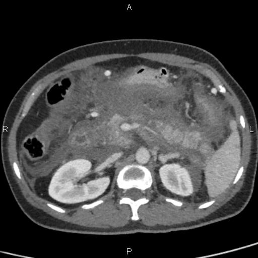 File:Bilateral adrenal gland hyperenhancement in pancreatitis (Radiopaedia 86642-102753 E 38).jpg