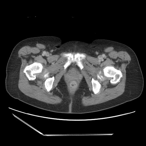 Bilateral adrenal granulocytic sarcomas (chloromas) (Radiopaedia 78375-91007 A 121).jpg