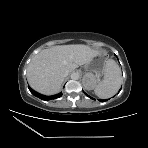 Bilateral adrenal granulocytic sarcomas (chloromas) (Radiopaedia 78375-91007 A 26).jpg