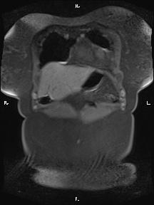 Bilateral adrenal myelolipoma (Radiopaedia 63058-71537 Coronal T1 fat sat 94).jpg