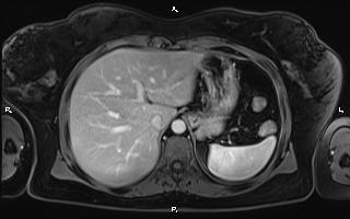 Bilateral adrenal myelolipoma (Radiopaedia 63058-71537 G 23).jpg