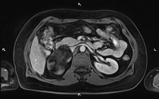 Bilateral adrenal myelolipoma (Radiopaedia 63058-71537 G 44).jpg