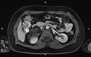 Bilateral adrenal myelolipoma (Radiopaedia 63058-71537 G 46).jpg