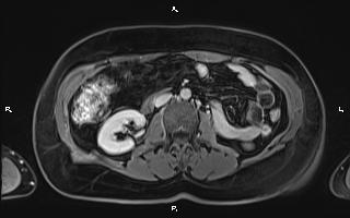File:Bilateral adrenal myelolipoma (Radiopaedia 63058-71537 H 57).jpg