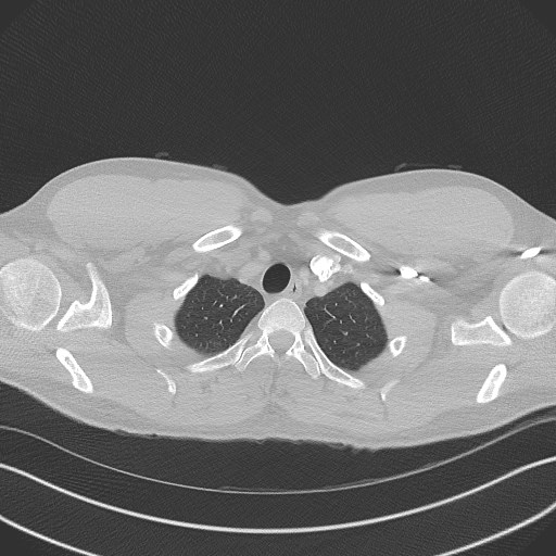Bilateral atelectasis (Radiopaedia 48666-53675 Axial lung window 8).jpg