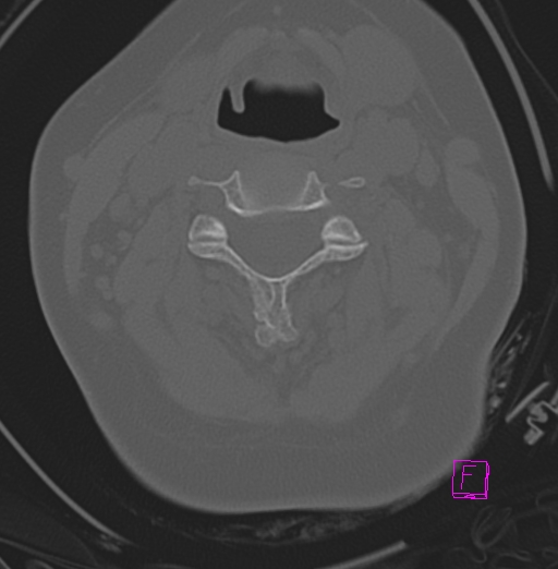 File:Bilateral atlanto-occipital assimilation (Radiopaedia 28350-28603 Axial bone window 19).jpg