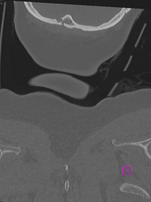 Bilateral atlanto-occipital assimilation (Radiopaedia 28350-28603 Coronal bone window 59).jpg