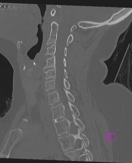 Bilateral atlanto-occipital assimilation (Radiopaedia 28350-28603 Sagittal bone window 35).jpg