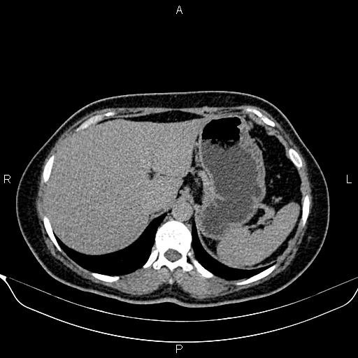 Bilateral benign adrenal adenomas (Radiopaedia 86912-103124 Axial C+ delayed 16).jpg