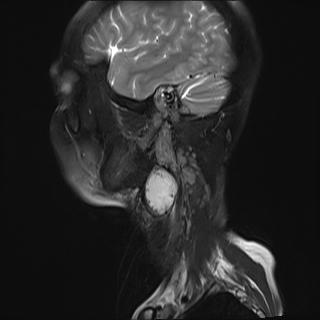 File:Bilateral carotid body tumors and right jugular paraganglioma (Radiopaedia 20024-20060 Sagittal 24).jpg