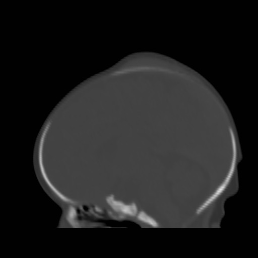 File:Bilateral cephalohematomas and subdural hematomas (Radiopaedia 26778-26929 Sagittal bone window 23).jpg