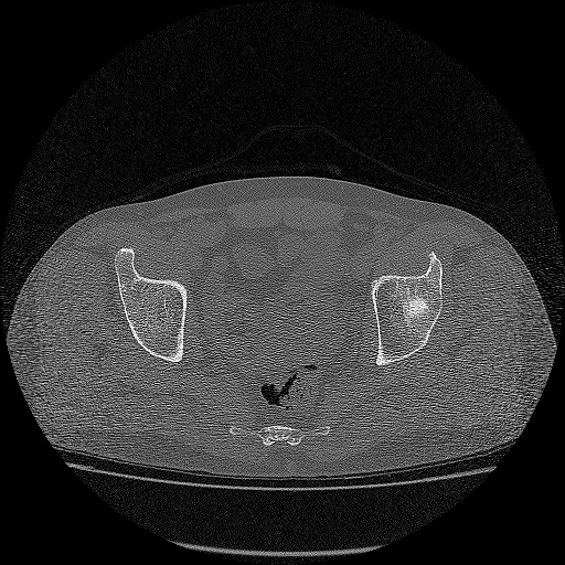 Bilateral femoral neck stress fractures (Radiopaedia 28666-28954 Axial bone window 3).png