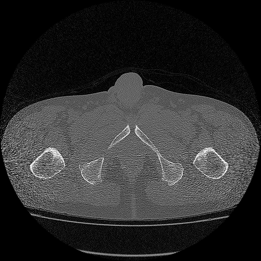 Bilateral femoral neck stress fractures (Radiopaedia 28666-28954 Axial bone window 76).png