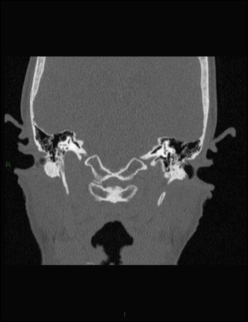 Bilateral frontal mucoceles (Radiopaedia 82352-96454 Coronal 316).jpg