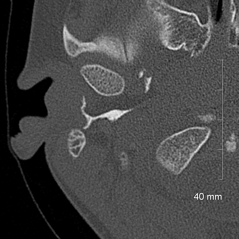 Bilateral grommets (Radiopaedia 47710-52404 Axial bone window 7).jpg
