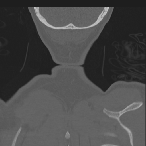 Bilateral locked facets (Radiopaedia 33850-35016 Coronal bone window 90).png