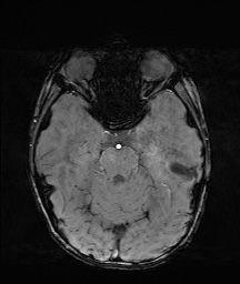 Bilateral mesial temporal polymicrogyria (Radiopaedia 76456-88181 Axial SWI 20).jpg