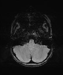 Bilateral mesial temporal polymicrogyria (Radiopaedia 76456-88181 Axial SWI 8).jpg