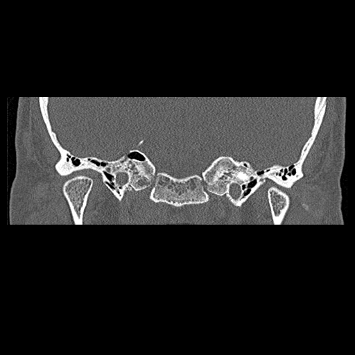 File:Bilateral ossifications of the external auditory canal (Radiopaedia 15233-15076 Coronal bone window 4).jpg