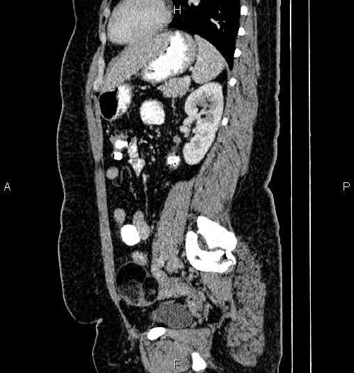 Bilateral ovarian dermoid cysts (Radiopaedia 85785-101603 D 63).jpg