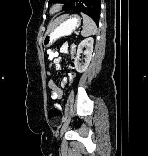 Bilateral ovarian dermoid cysts (Radiopaedia 85785-101603 D 69).jpg