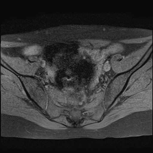 File:Bilateral ovarian endometriomas (Radiopaedia 87085-103347 Axial T1 fat sat 7).jpg