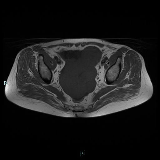 File:Bilateral ovarian fibroma (Radiopaedia 44568-48293 Axial T1 15).jpg