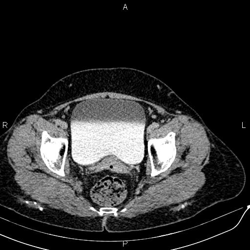 Bilateral ovarian serous cystadenocarcinoma (Radiopaedia 86062-101989 Axial C+ delayed 73).jpg