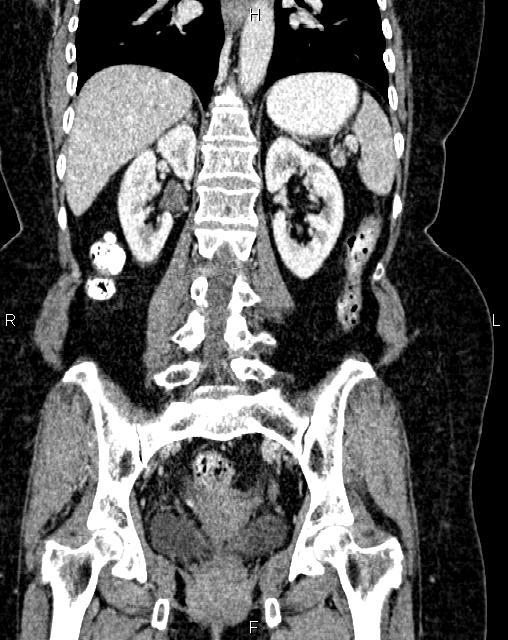 Bilateral ovarian serous cystadenocarcinoma (Radiopaedia 86062-101989 D 33).jpg