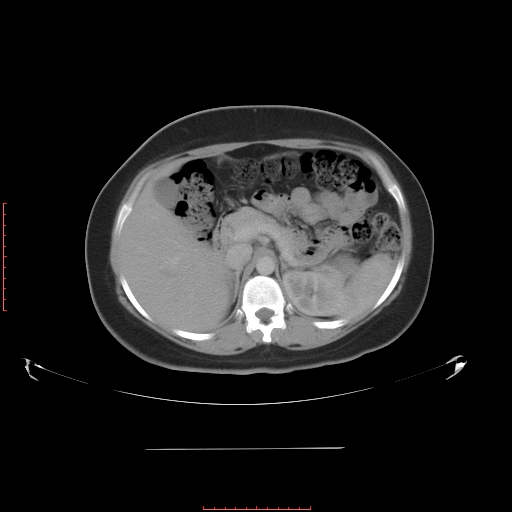 File:Bilateral ovarian serous cystadenocarcinoma with right ovarian torsion (Radiopaedia 32640-33611 A 12).jpg