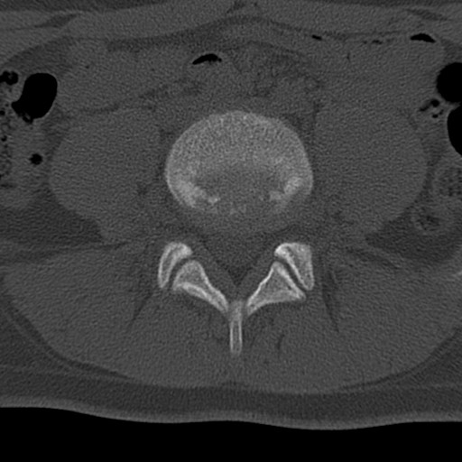 Bilateral pars defect (Radiopaedia 26691-26846 Axial bone window 40).jpg