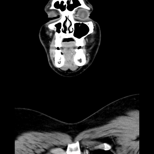 Bilateral peritonsillar abscess (Radiopaedia 85065-100610 Coronal 15).jpg