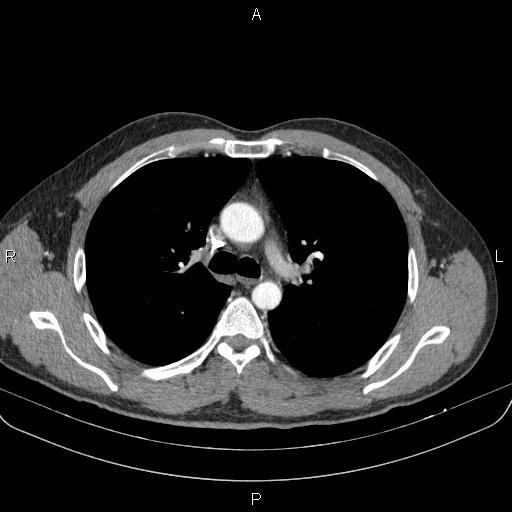 Bilateral pulmonary AVM (Radiopaedia 83134-97505 A 27).jpg