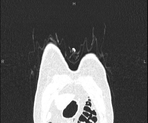 Bilateral pulmonary AVM (Radiopaedia 83134-97505 Coronal lung window 8).jpg