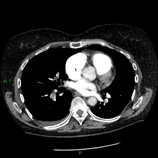File:Bilateral pulmonary emboli (Radiopaedia 32700-33669 Axial C+ CTPA 60).jpg